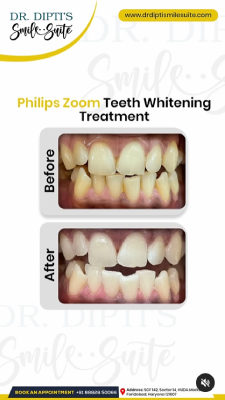 best teeth whitening in faridabad